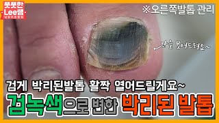 검게로 변한 박리된 오른쪽발톱 관리 활짝 열어드릴게요 tinea unguium  athletes foot  Fresh Foot 성수점  남양주호평점 [upl. by Airetnuhs]