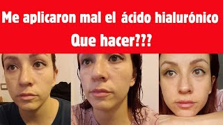 Me aplicaron mal el ácido hialurónico en las ojeras lo que debes saber acidohialuronico ojeras [upl. by Sadonia]