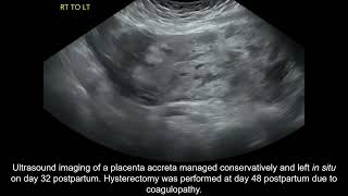 Placenta accreta spectrum conservative management and coagulopathy [upl. by Sylado]