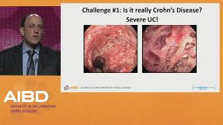 Challenges in the treatment of severe Crohns disease [upl. by Ygiaf119]