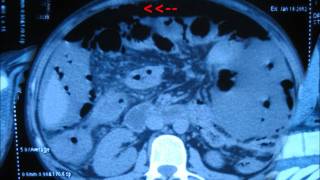 Bowel perforation CT scan features [upl. by Nebuer]