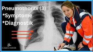 Pneumothorax Teil 3 Symptome Auskultation Sonografie Röntgen einfach erklärt [upl. by Tloh]