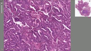 Endometrial Adenocarcinoma  Histopathology [upl. by Jone308]