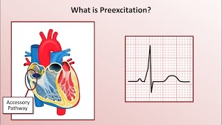 Advanced EKGs  WolffParkinsonWhite WPW Syndrome [upl. by Ydnil932]