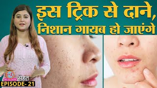 Acne Scars Pimples से कैसे छुटकारा पाएं खुद Doctors से सुने  Sehat Ep 21 [upl. by Albie]