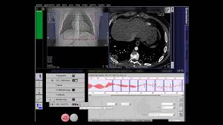 CT ECG Editing [upl. by Kinnie]