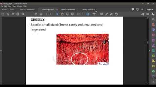 L79 PATHOLOGY NON NEOPLASTIC POLYPS [upl. by Ettelimay274]