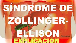 Qué es el Síndrome de Zollinger Ellison Explicación [upl. by Eirod362]