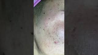 Black Head Removal Men Face [upl. by Ettedualc773]