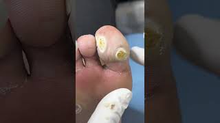 Dead skin removal and Cracked heels treatment Callus removal from feet ep137 Cao​Clinic [upl. by Junno581]