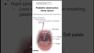 Pediatric obstructive sleep apnea [upl. by Aieken]