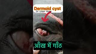 Dermoid cyst l dr Umar khan [upl. by Hugon]