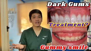 GUMMY SMILE DARK GUMS and UNEVEN TEETH Treaments Gingivectomy Gum Bleaching and Enameloplasty [upl. by Iahs]