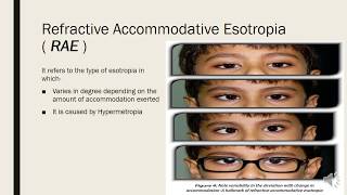 Accommodative Esotropia  Introduction amp Refractive accommodative esotropia [upl. by Nnahs]