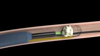 Calculo Renal Tratamiento mediante fragmentacion interna Urologia Peruana [upl. by Hersh]