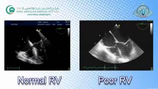 047 RV function amp Pulmonary Embolism TEE KAMC [upl. by Wohlen]