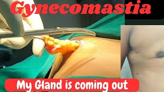 Grade 1 Gynecomastia surgery Gynecomastia surgery without any mark By DrPanksj Kumar [upl. by Sobel]