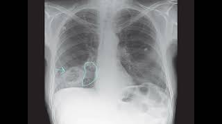 Deciphering a Mysterious Lung Lesion Radiology Case Analysisquot [upl. by Nnasus]