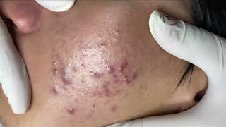 Blackheads amp Whiteheads Removal New 2024 Acne Treatment With Nhat Bang [upl. by Bab732]