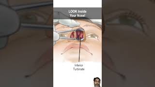 Nasal obstruction due to turbinate hypertrophy doctor nasalcongestion anatomy animation [upl. by Revlis]