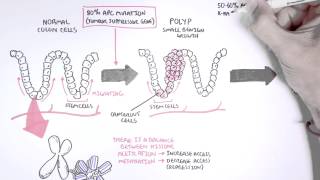 Colon Cancer Carcinogensis [upl. by Sherr]