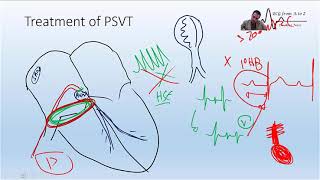 the Exact place of the slow AVN pathway and How we ablate AVNRT [upl. by Domenech]