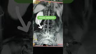 Psoas Abscess Mri Lumbar Spine viral mri shorts [upl. by Romeu]