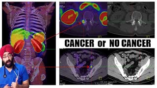 PET CT Scan can detect any and all CANCER in your Body  DrEducation [upl. by Nolham]