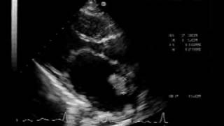 MS different aspectsmitral stenosis with LA thrombus [upl. by Steffy231]