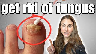 Get Rid Of Toenail Fungus With These 4 Easy Home Remedies [upl. by Auqinal]