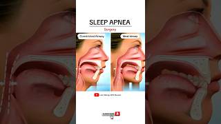 Sleep apnea surgery  Animated Video [upl. by Mossman122]