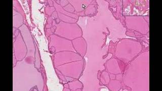 Histopathology ThyroidColloid goiter [upl. by Morty51]