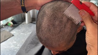 How to get rid old dandruff flakes scratching super care 🥵😱💯 how to get rid of dry scaly skin [upl. by Alliuqat]