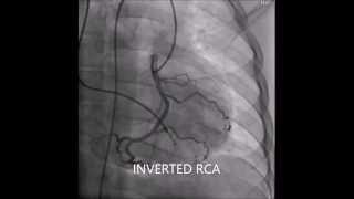 Inverted coronary arteries of corrected transposition of great arteries [upl. by Ellenaej501]