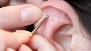 CHINESE AURICULAR ACUPUNCTURE 01 Principles [upl. by Feeley209]