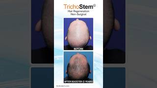 Other ACellPRP Vs TrichoStem Hair Regeneration Cost and Treatment Frequency hairloss [upl. by Amzaj471]