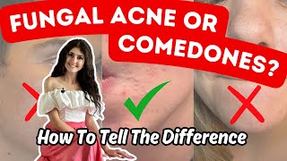 Fungal Acne VS Closed Comedones  Top 5  1 Practical Differences [upl. by Hatfield]