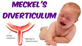 Meckels Diverticulum [upl. by Jeri]