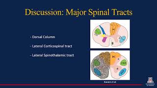 Traumatic Brown Sequard Syndrome A Review of Anatomy and Imaging [upl. by Cosmo473]