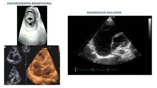 ESTENOSIS TRICUSPÍDEA [upl. by Ahsenor]