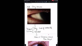 Case 7 Xerophthalmia Vitamin A Deficiency [upl. by Gold]