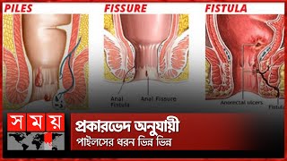 পাইলস ফিসার ও ফিস্টুলার মধ্যে পার্থক্য কী  Piles  Fissure  Fistula  Somoy TV [upl. by Margarette]