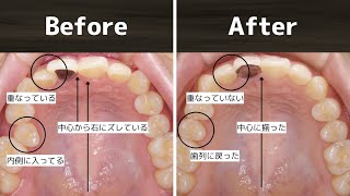 【症例85】前歯の重なりや位置が気になる歯並びのお悩みを表側矯正で改善したケース｜山口県宇部市「歯科・矯正歯科アールクリニック」の症例動画 [upl. by Tiler756]