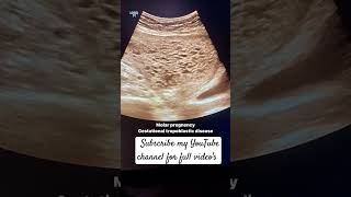 Molar pregnency in ultrasoundusg of pelvis Molar pregnancy ultrasound [upl. by Eedissac306]