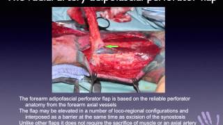 Adipofascial flaps for post traumatic forearm synostosis [upl. by Lerret]