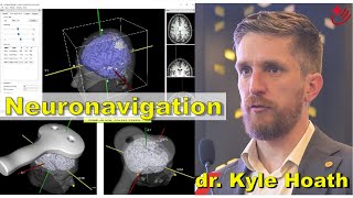 TMS  Neuronavigation  dr Kyle Hoath Australia [upl. by Ahsimik]