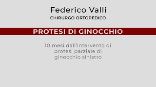 Protesi di Ginocchio 10 mesi dalloperazione di protesi parziale [upl. by Ahsem]