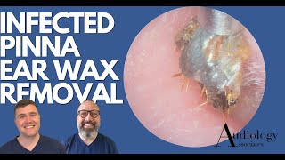 INFECTED PINNA EAR WAX REMOVAL  EP880 [upl. by Farley]