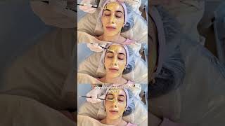 Yellow Peel Peeling YellowPeel Acne acnetreatment [upl. by Winona68]