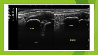 Osteochrondrose du cartilage de croissance en échographie [upl. by Behl]